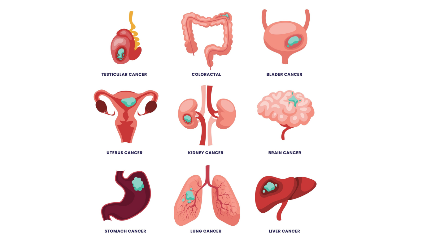From First to Final Stage: How Cancer Progresses, Diagnosis, Treatment, Diet & Survival Chances Explained