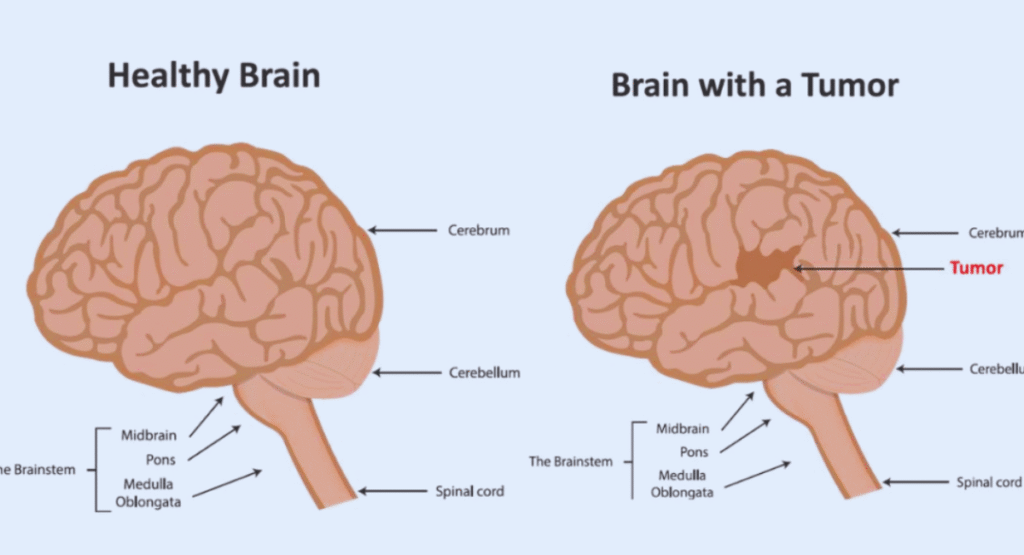 Brain Tumor: Causes, Symptoms, Treatment, Recovery & Doctor’s Advice – Complete Guide