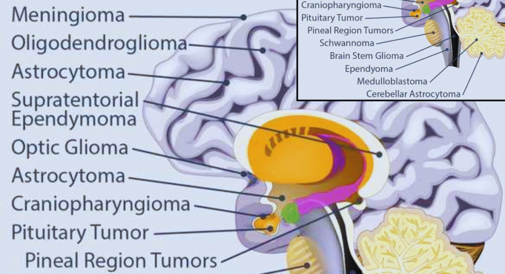 Brain Tumor: Causes, Symptoms, Treatment, Recovery & Doctor’s Advice – Complete Guide